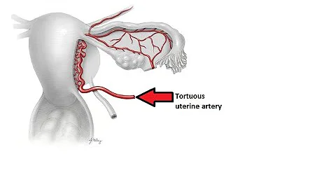 Mastering Uterine Artery Anatomy: A Concise Summary Included
