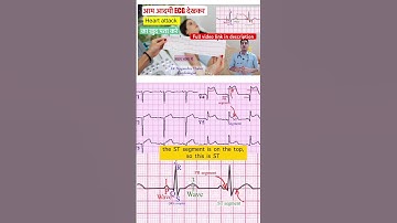 Check heart attack ECG by yourself l ईसीजी देखकर ख़ुद पता करे हार्ट अटैक #ecg #echo #shorts