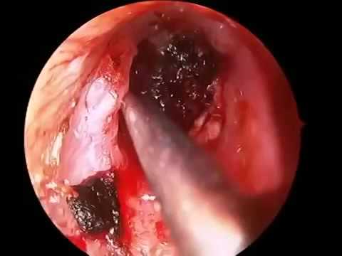 in infections adults Symptoms severe of ear