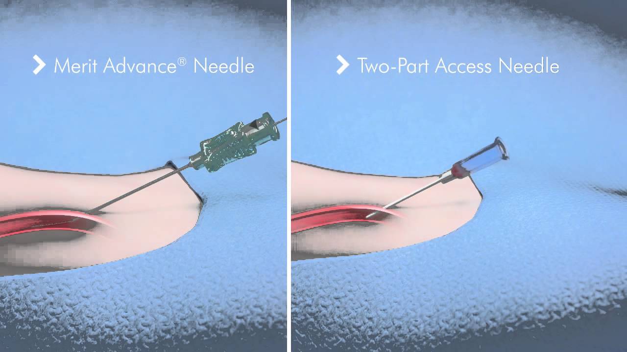 PreludeEASE Hydrophilic Sheath Introducer YouTube PreludeEASE Hydrophilic Sheath Introducer YouTube
