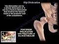Hip Dislocation - Everything You Need To Know - Dr. Nabil Ebraheim