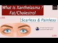 What is xanthelasma  fat deposit  shobhit aesthetics