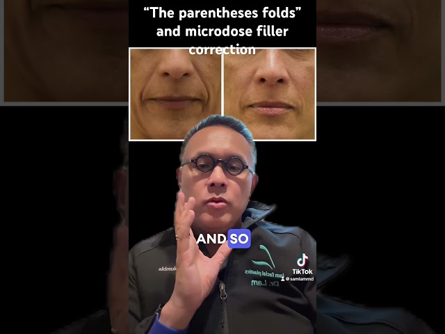 “The parentheses folds” and microdose filler correction