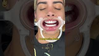 Before and After/ Composite Resin  #dentist #smiledental #teeth #dentalveneers #dental #perfectteeth