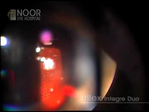 Video: Léčí panretinální fotokoagulace diabetickou retinopatii?