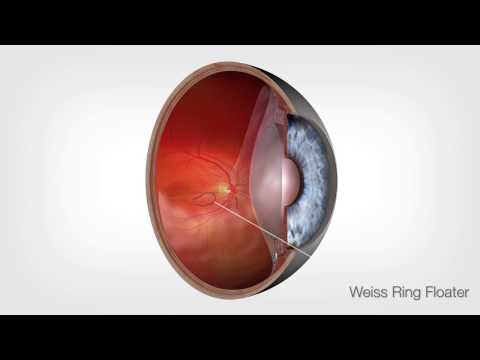 Vitreous Floater Ablation Animation