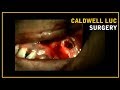 Caldwell luc surgery