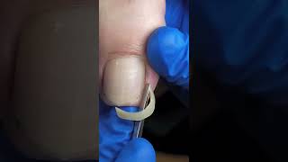 Satisfying nail cleaning process#nailcare #pedicure #satisfying #nailtech #oddlysatisfying #fyp