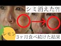 【シミに効果大⁉️】レモン水は、魔法のお水だった。3ヶ月で驚くほどシミが薄く‼️