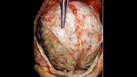 Hersenvliezen (meninges) en liquor