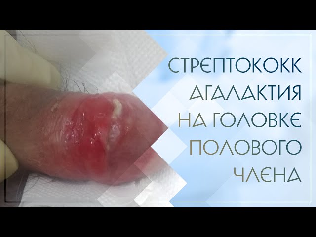 Streptococcus agalactiae пенис пилингі