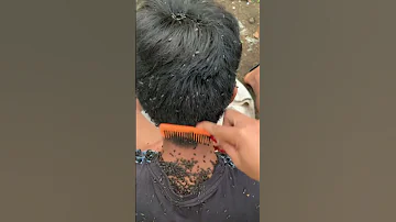 قمل الشعر 