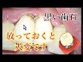 【歯石】縁下の除去と注意事項