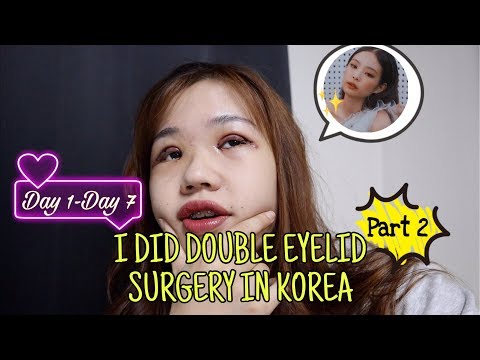 I DID DOUBLE EYELID SURGERY IN KOREA!!! PART 2!!!