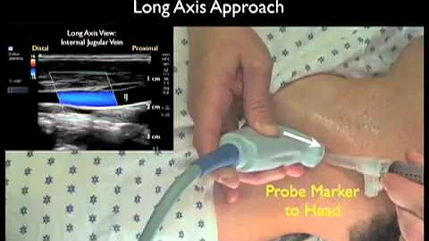 How To: Ultrasound Guidance for Central Venous Access Part 2 Case Study Video