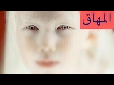 المعادله المهاق