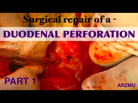 Duodenal Perforation | Part 1 | Open surgical repair of duodenal (DU) or Peptic Ulcer Perforation