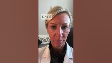 😱 The recovery behind a CO2 laser skin resurfacing! Don