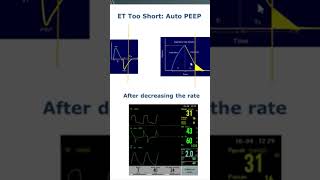 Short expiratory time and auto PEEP graphics waveforms neonatalventilation