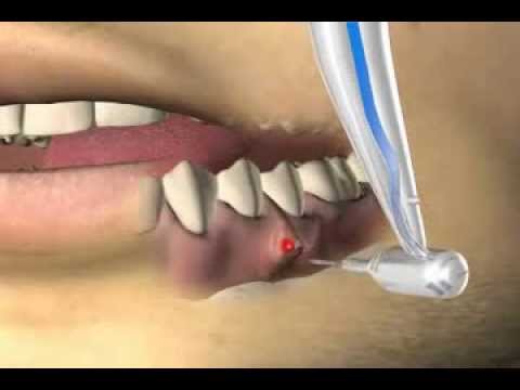 Video: Behandlung Einer Zahnzyste Ohne Extraktion: Mögliche Optionen