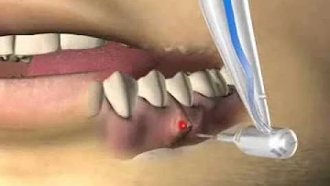 Wie wird eine Zyste am Zahn entfernt?