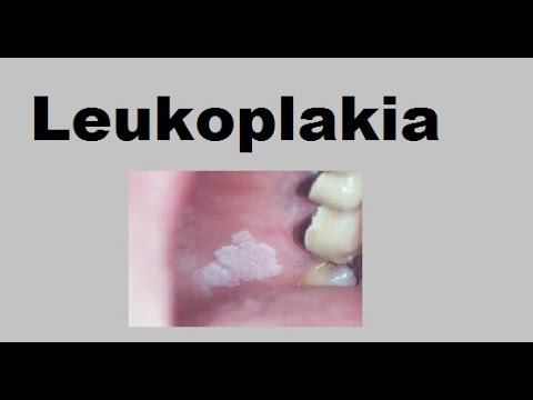 Video: Leukoplakia - Sümptomid, Ravi, Lihtne Ja Karvane Leukoplakia