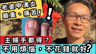 甲溝炎，可以三日就好？！ 簡單不花錢就做到？！。 #甲溝炎 #主婦手 #濕疹 #皮膚過敏 ￼