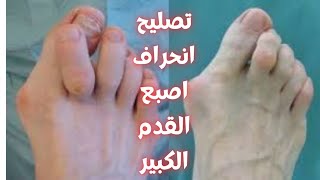 علاج انحراف إصبع القدم الكبير/انحراف إبهام القدم/علاج انحراف إبهام القدم/علاج اصبع القدم الكبير