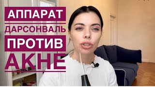 Дарсонваль. Лечение акне. Покупать или нет.