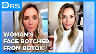 How Woman Fixed Her Face Botched by Botox!