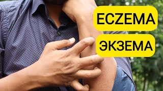 ECZEMA | ЭКЗЕМА