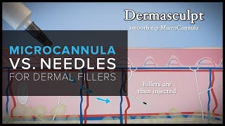 Microcannula Vs. Needles For Dermal Fillers In San Francisco