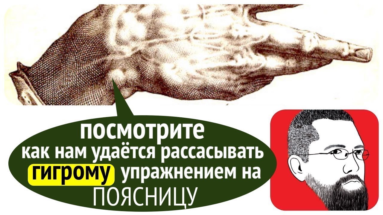 ГИГРОМА ЗАПЯСТЬЯ без операции - YouTube