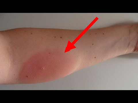 Чем снять отек от укуса комара или мошки.  Что делать после укуса насекомого