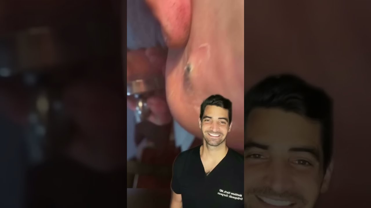 BB Removal