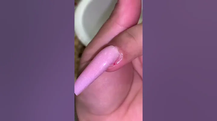 MY WHOLE NAIL RIPPED OFF…😱🤢 (UPDATE) - DayDayNews