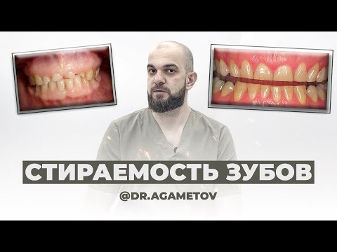 Стираемость зубов. Проблемы в суставе. Почему важно ортодонтическое лечение?