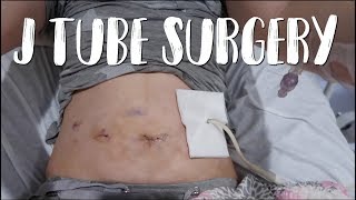 Straight J Tube (Jejunostomy) Surgery | Feeding Tube For Gastroparesis