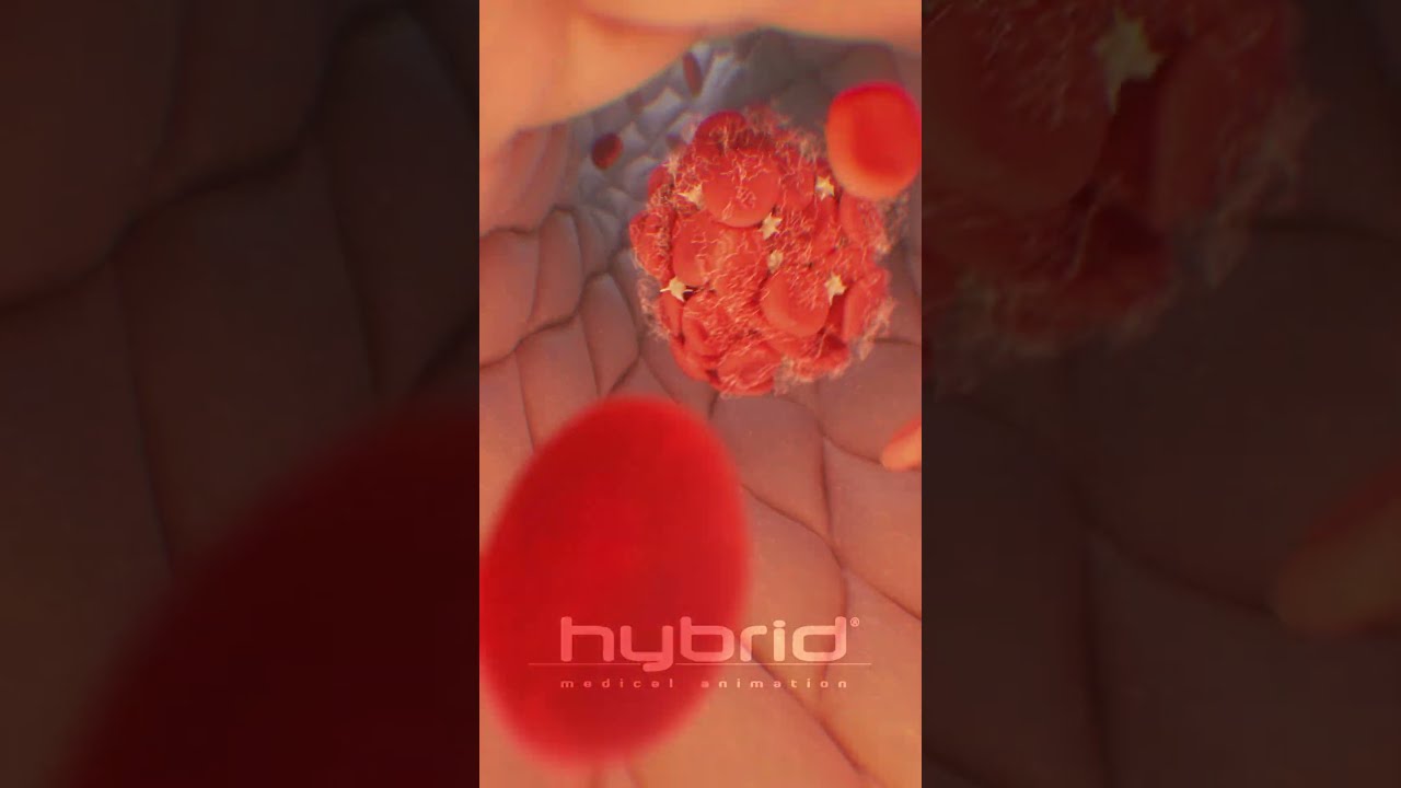 Venous Thromboembolism Deep Vein Thrombosis DVT Medicalanimation Bloodclot