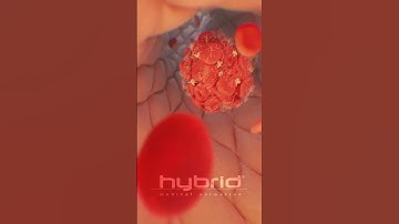 Venous thromboembolism | Deep vein thrombosis (DVT)  | #thrombosis  #medicalanimation #bloodclot