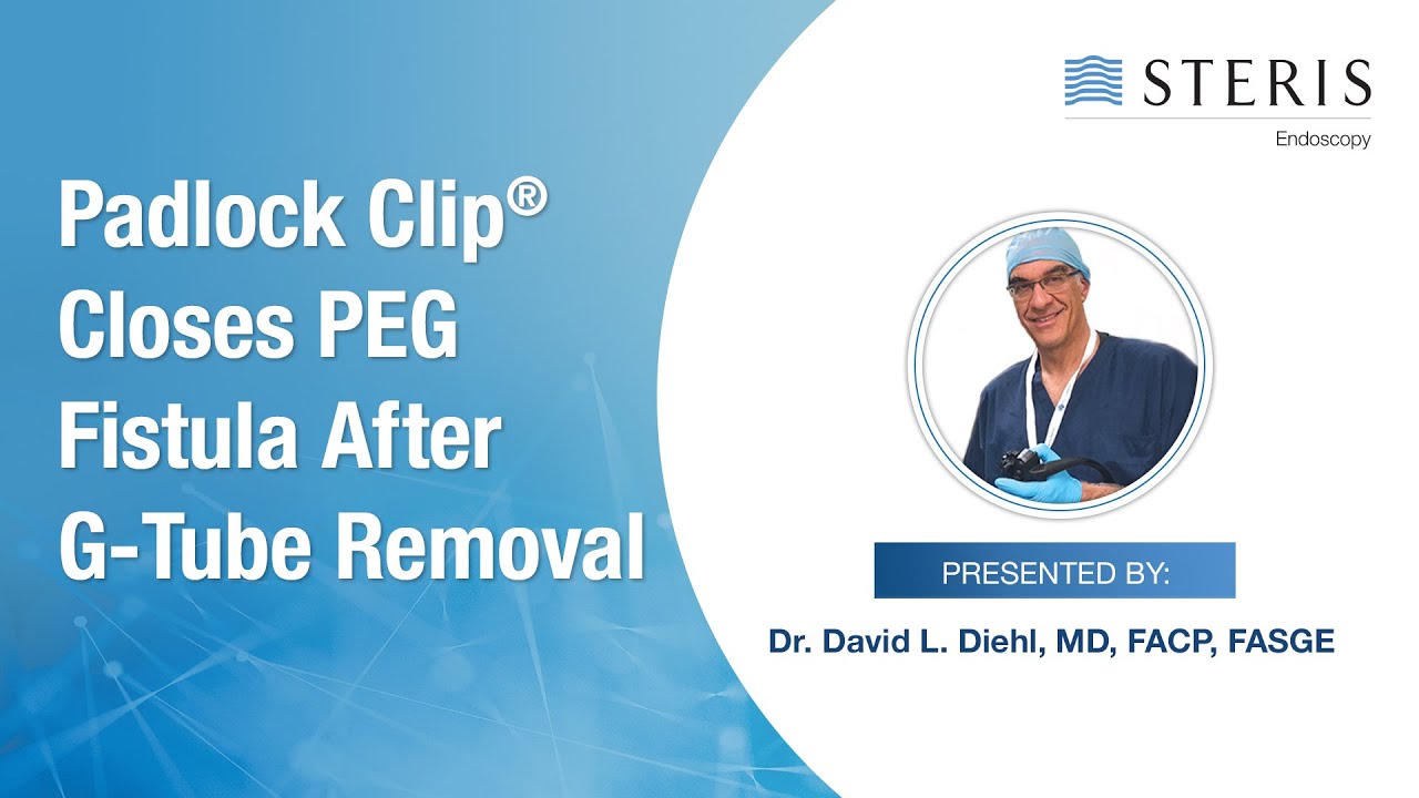 Padlock Clip® Closes PEG fistula after G-tube Removal – Dr. Diehl - YouTube