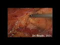 Laparoscopic nephron sparing surgery for RENAL SCORE 10x