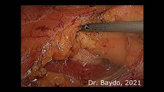 Laparoscopic nephron sparing surgery for RENAL SCORE 10x