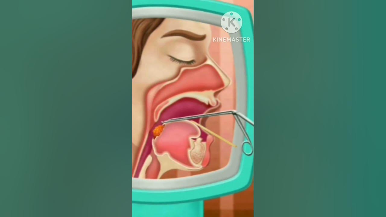 robotic-tongue-cancer-surgery-youtube