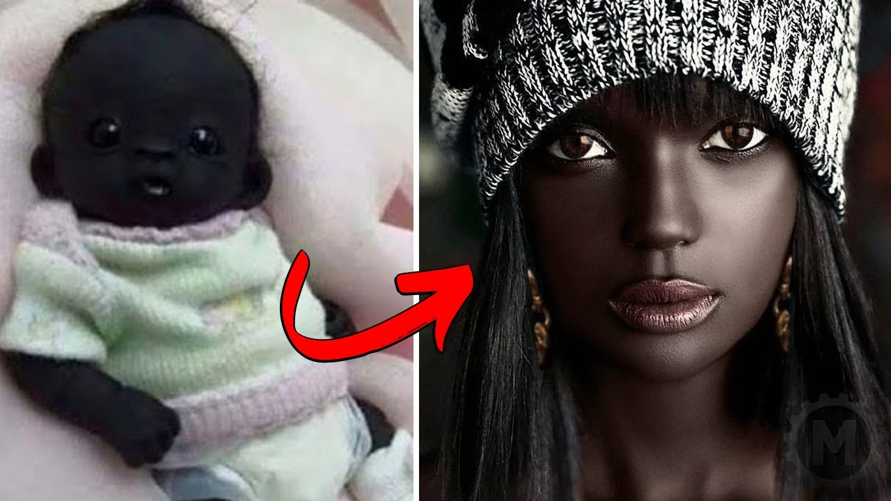 Værdiløs At bygge angreb Unusual People Born With Unique Skin Colors - YouTube