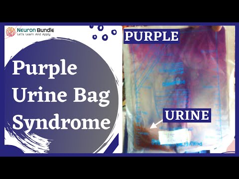 Purple Urine Bag Syndrome : Aetiology, management  #urinediscolouration #uti #medschool