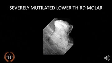 Customised Resin Matrix for deep margin elevation .Useful in case of heavily broken teeth .