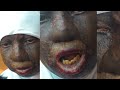 unknown disease is kIlling this young lady ; She Needs Help