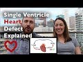 Single Ventricle Heart Defect and Treatment Explained - DILV