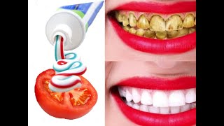 تبييض الاسنان بدون طبيب وتبييض ناصع بدون ليزر teeth whitening
